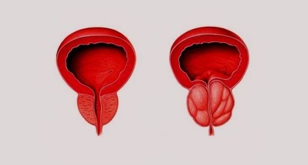 Здрава простата (вляво) и възпалена поради простатит (вдясно)